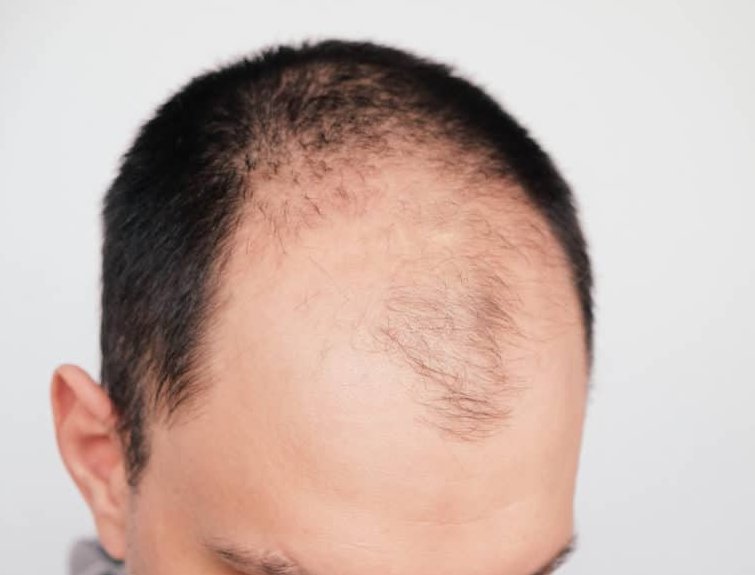5 Effective Remedies for Thinning Hair